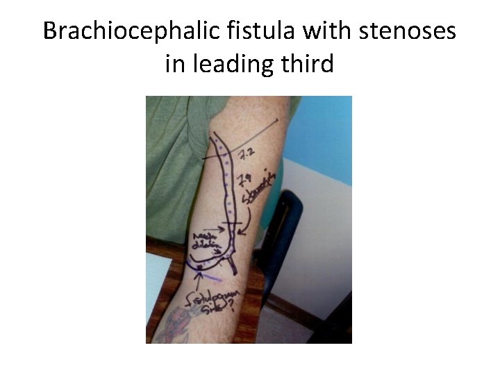 Brachiocephalic fistula with stenoses in leading third 