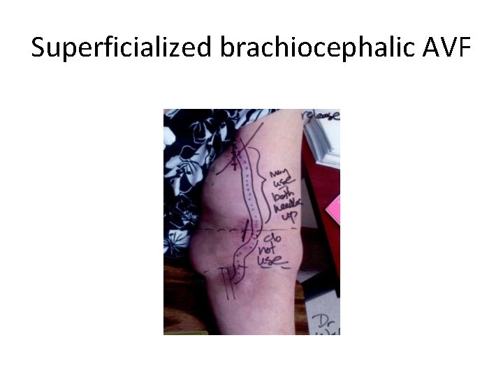 Superficialized brachiocephalic AVF 