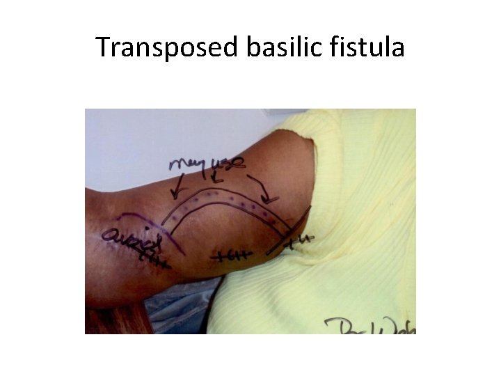 Transposed basilic fistula 