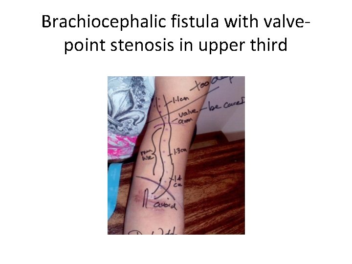 Brachiocephalic fistula with valvepoint stenosis in upper third 