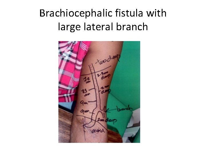 Brachiocephalic fistula with large lateral branch 
