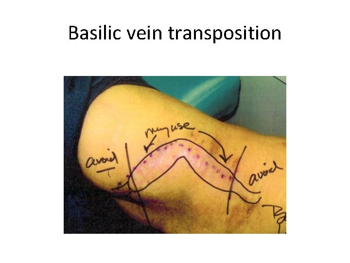 Basilic vein transposition 