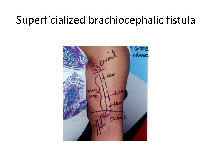Superficialized brachiocephalic fistula 