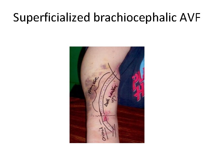 Superficialized brachiocephalic AVF 