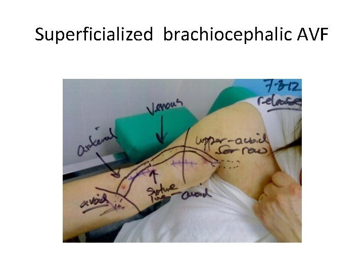 Superficialized brachiocephalic AVF 