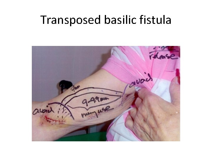 Transposed basilic fistula 