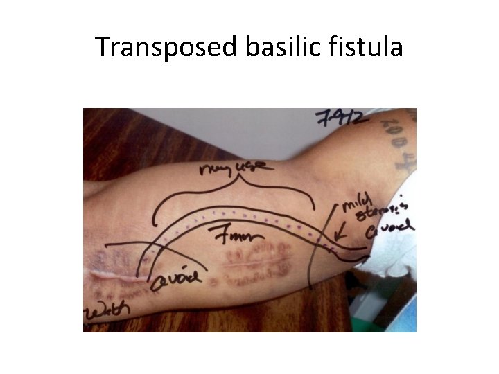 Transposed basilic fistula 