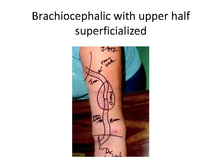 Brachiocephalic with upper half superficialized 