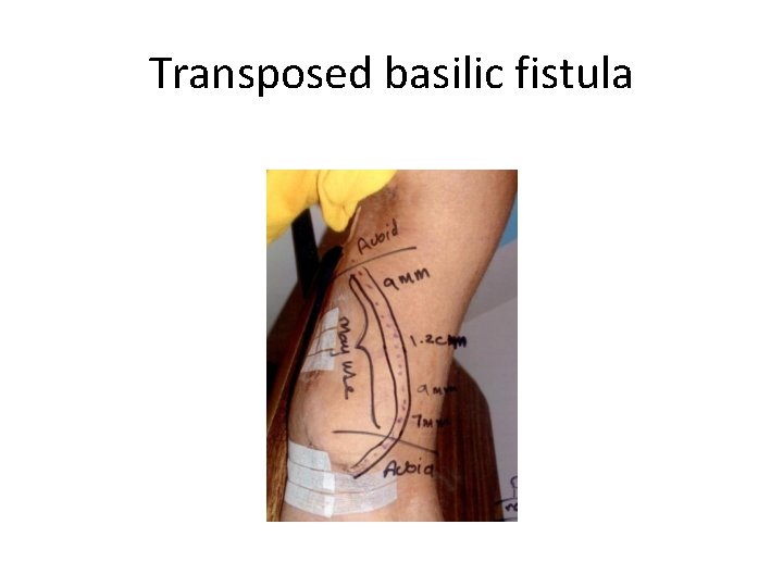 Transposed basilic fistula 