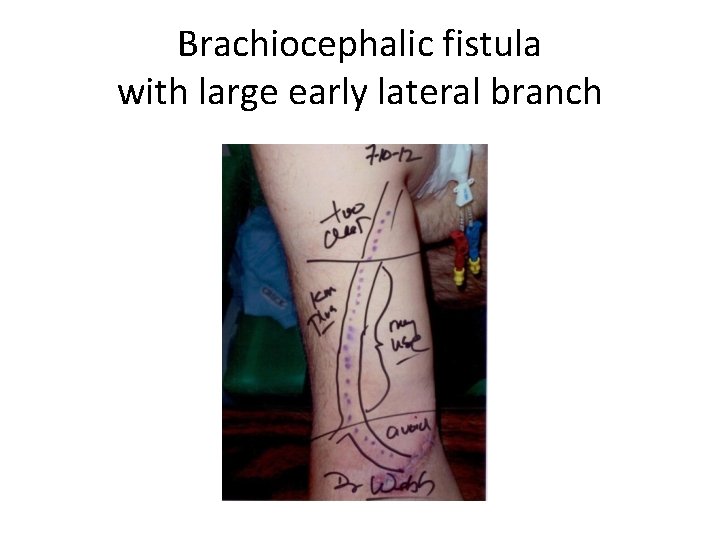 Brachiocephalic fistula with large early lateral branch 