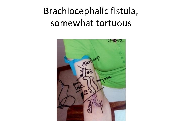 Brachiocephalic fistula, somewhat tortuous 