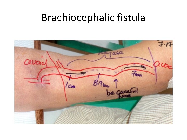 Brachiocephalic fistula 