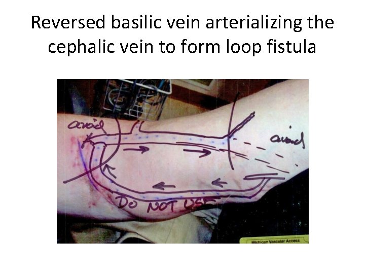 Reversed basilic vein arterializing the cephalic vein to form loop fistula 