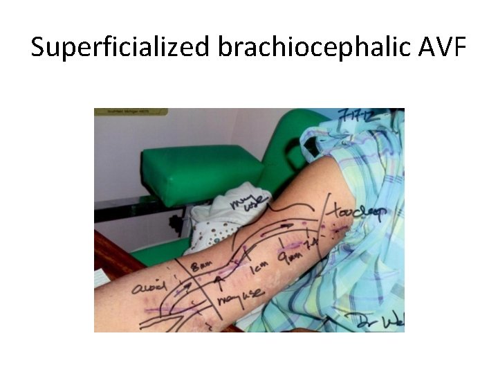 Superficialized brachiocephalic AVF 