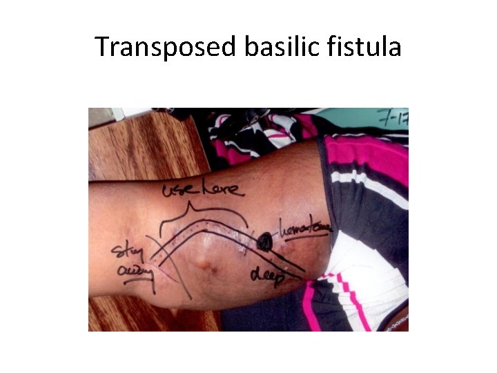 Transposed basilic fistula 