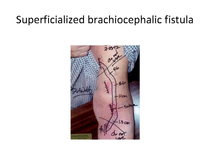 Superficialized brachiocephalic fistula 