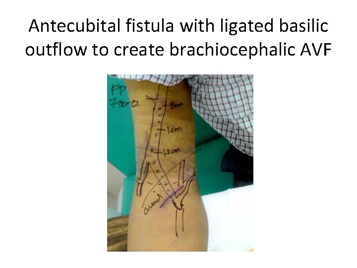 Antecubital fistula with ligated basilic outflow to create brachiocephalic AVF 