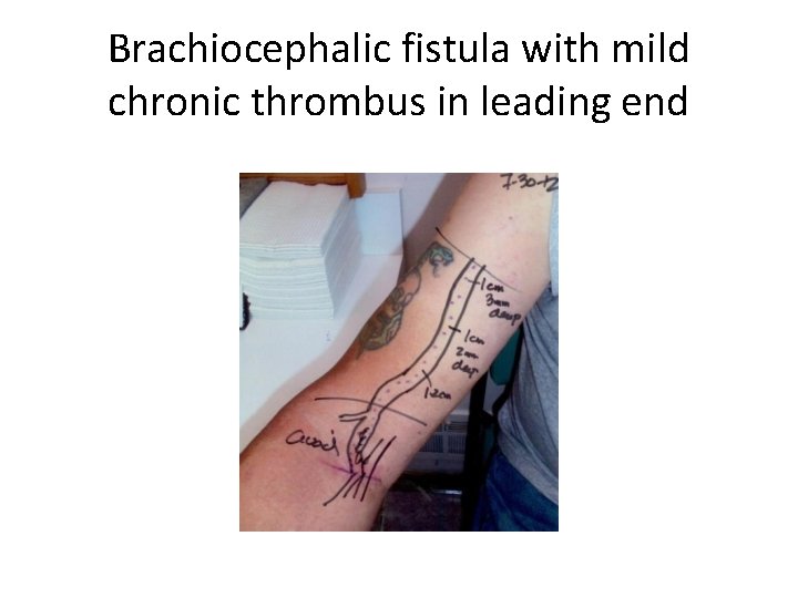 Brachiocephalic fistula with mild chronic thrombus in leading end 