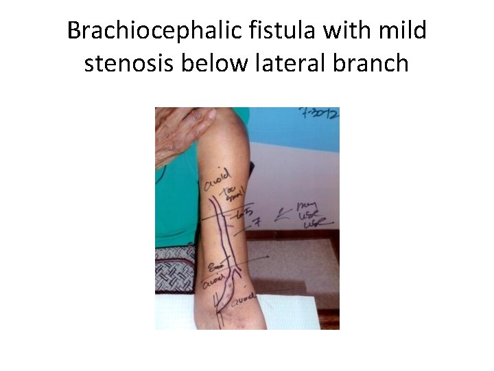 Brachiocephalic fistula with mild stenosis below lateral branch 