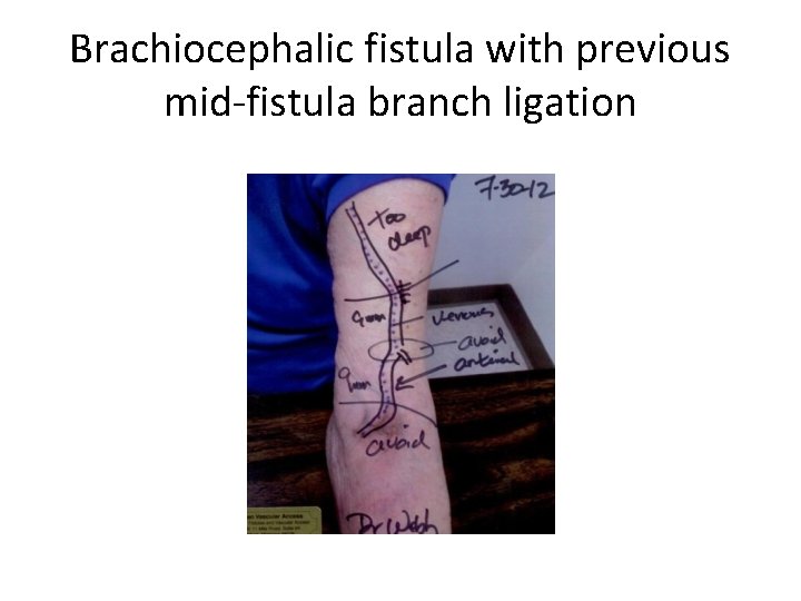 Brachiocephalic fistula with previous mid-fistula branch ligation 