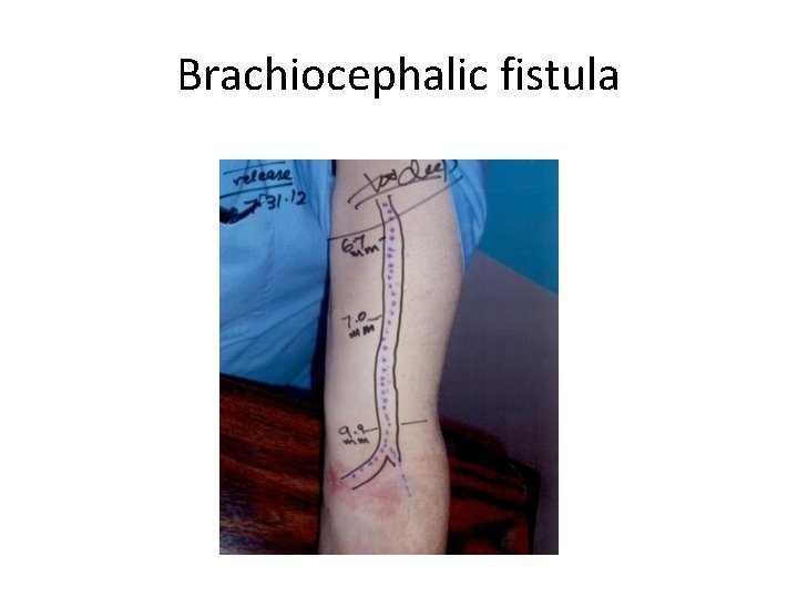 Brachiocephalic fistula 