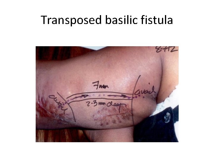 Transposed basilic fistula 