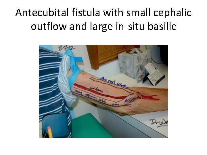 Antecubital fistula with small cephalic outflow and large in-situ basilic 