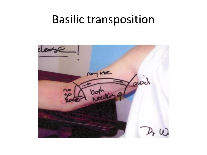 Basilic transposition 