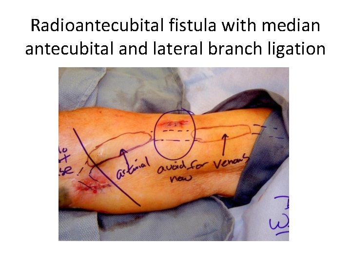 Radioantecubital fistula with median antecubital and lateral branch ligation 