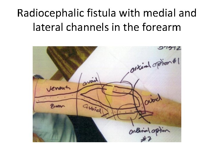 Radiocephalic fistula with medial and lateral channels in the forearm 
