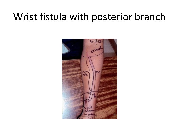 Wrist fistula with posterior branch 