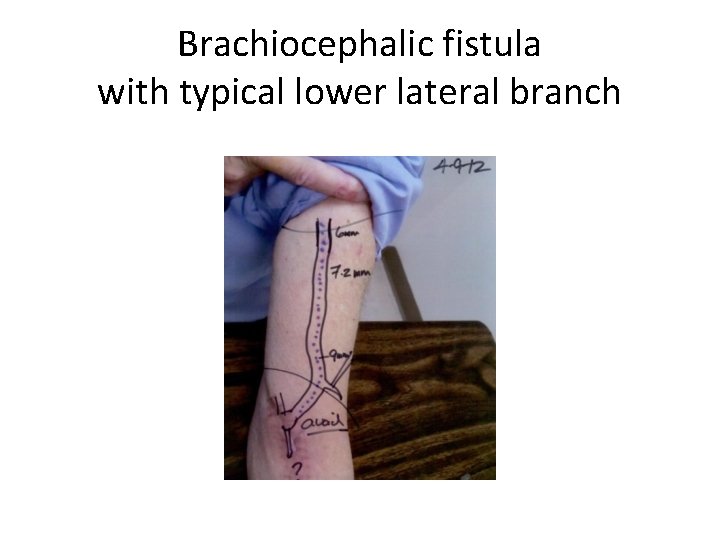 Brachiocephalic fistula with typical lower lateral branch 