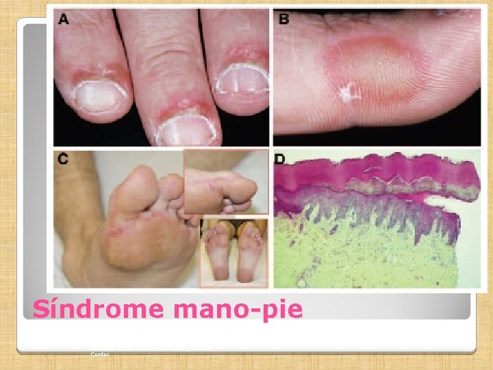 Síndrome mano-pie Courtesy of Cleveland Clinic Taussig Cancer Center 