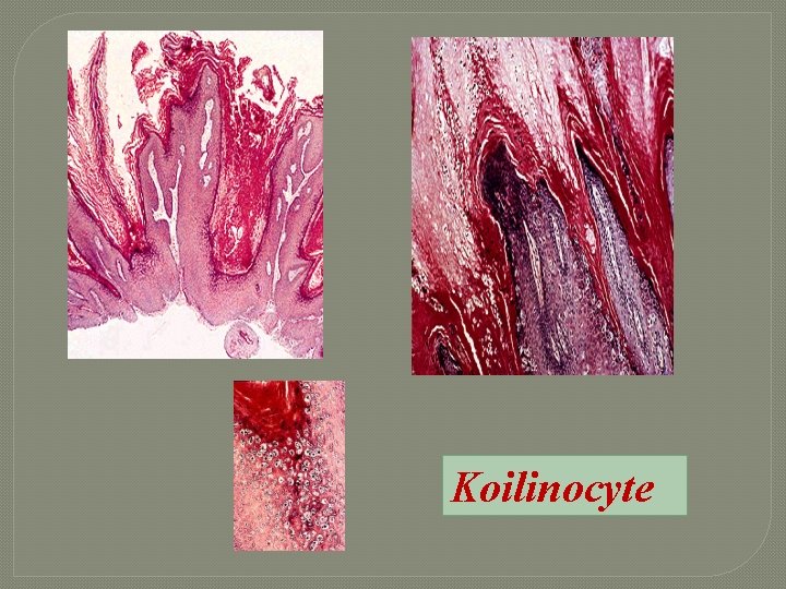 Koilinocyte 