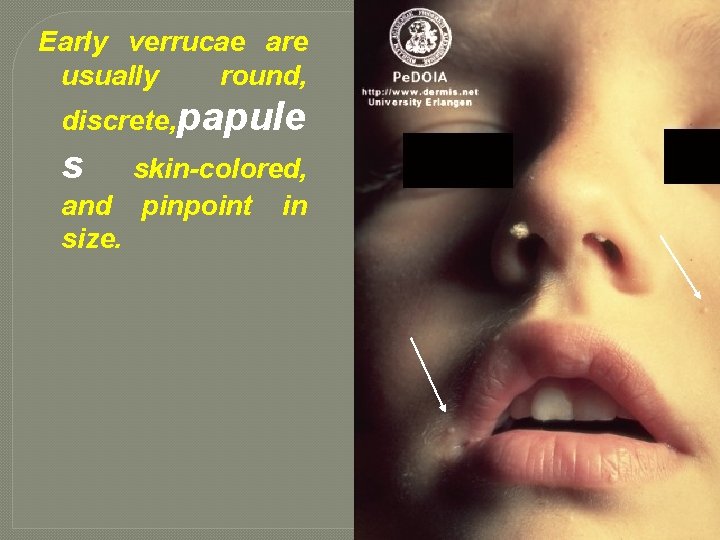 Early verrucae are usually round, discrete, papule s skin-colored, and pinpoint in size. 