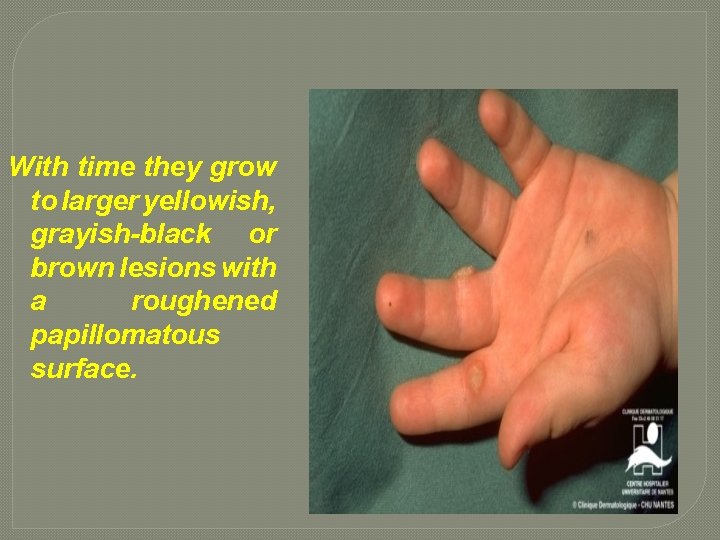 With time they grow to larger yellowish, grayish-black or brown lesions with a roughened