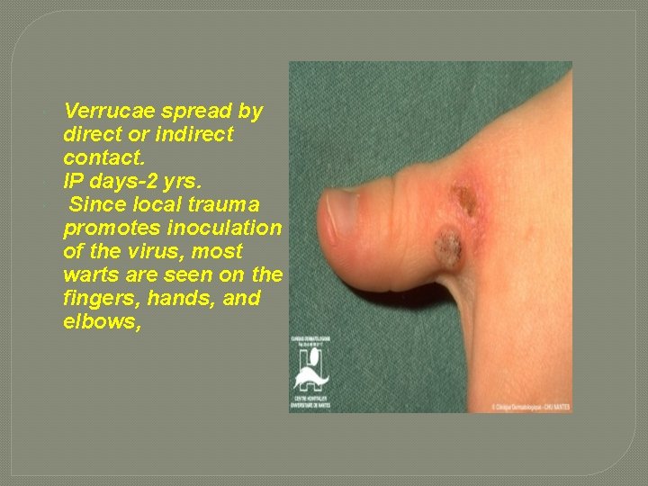  Verrucae spread by direct or indirect contact. IP days-2 yrs. Since local trauma