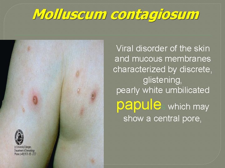 Molluscum contagiosum Viral disorder of the skin and mucous membranes characterized by discrete, glistening,