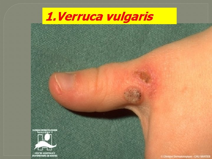 1. Verruca vulgaris 