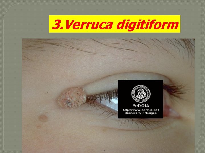 3. Verruca digitiform 