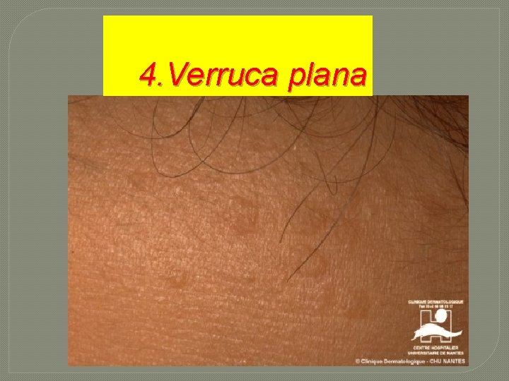 4. Verruca plana 