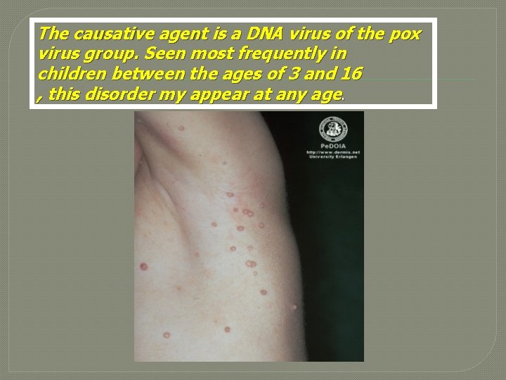 The causative agent is a DNA virus of the pox virus group. Seen most