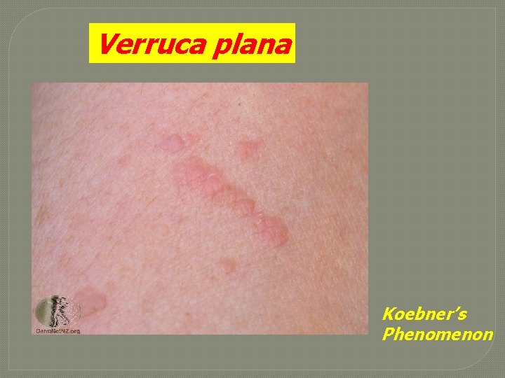 Verruca plana Koebner’s Phenomenon 