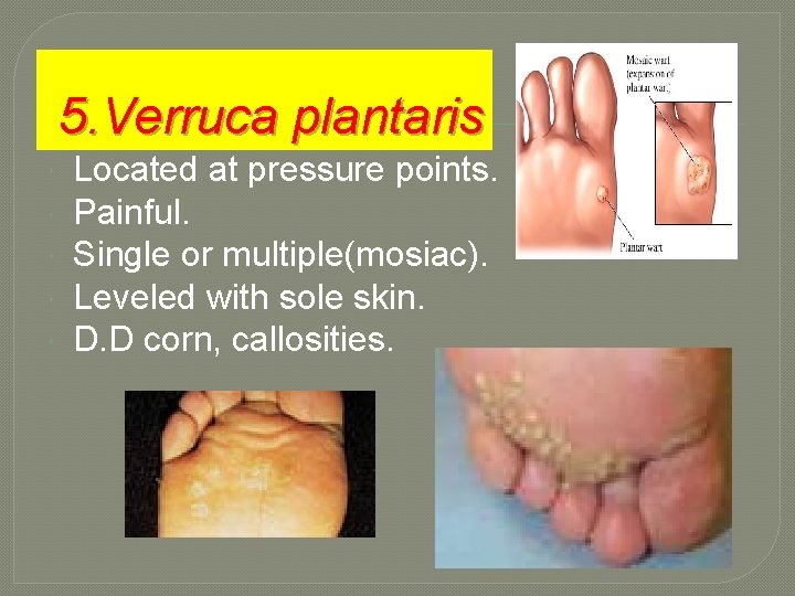 5. Verruca plantaris Located at pressure points. Painful. Single or multiple(mosiac). Leveled with sole