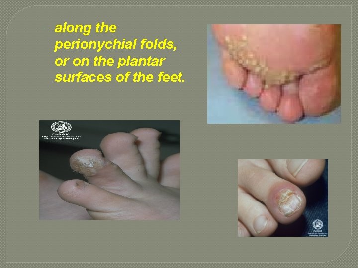  along the perionychial folds, or on the plantar surfaces of the feet. 