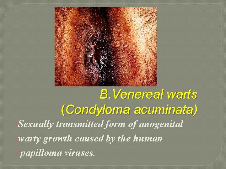 B. Venereal warts (Condyloma acuminata) l. Sexually transmitted form of anogenital lwarty growth caused