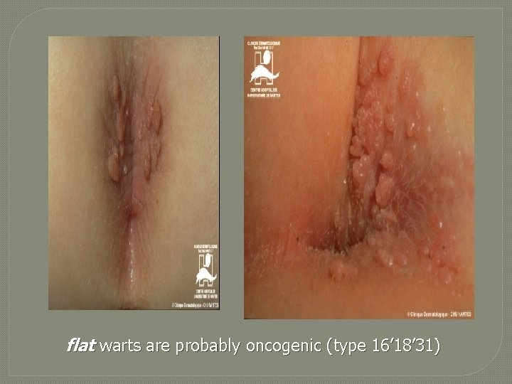 flat warts are probably oncogenic (type 16’ 18’ 31) 