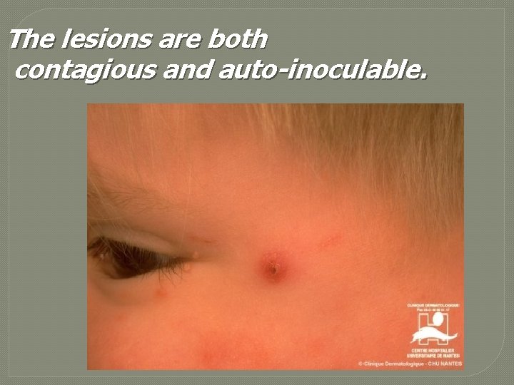 The lesions are both contagious and auto-inoculable. 