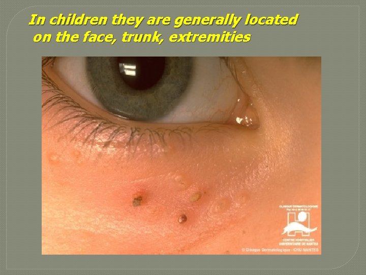 In children they are generally located on the face, trunk, extremities 