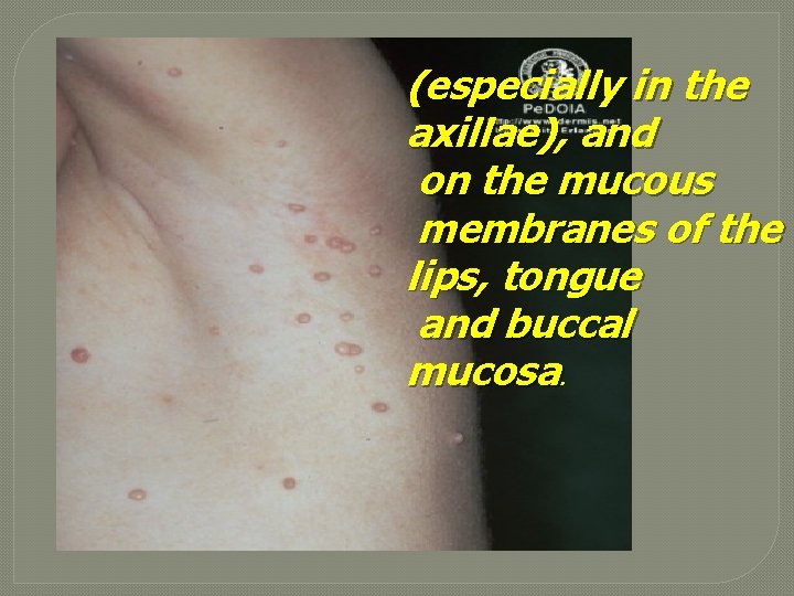 (especially in the axillae), and on the mucous membranes of the lips, tongue and